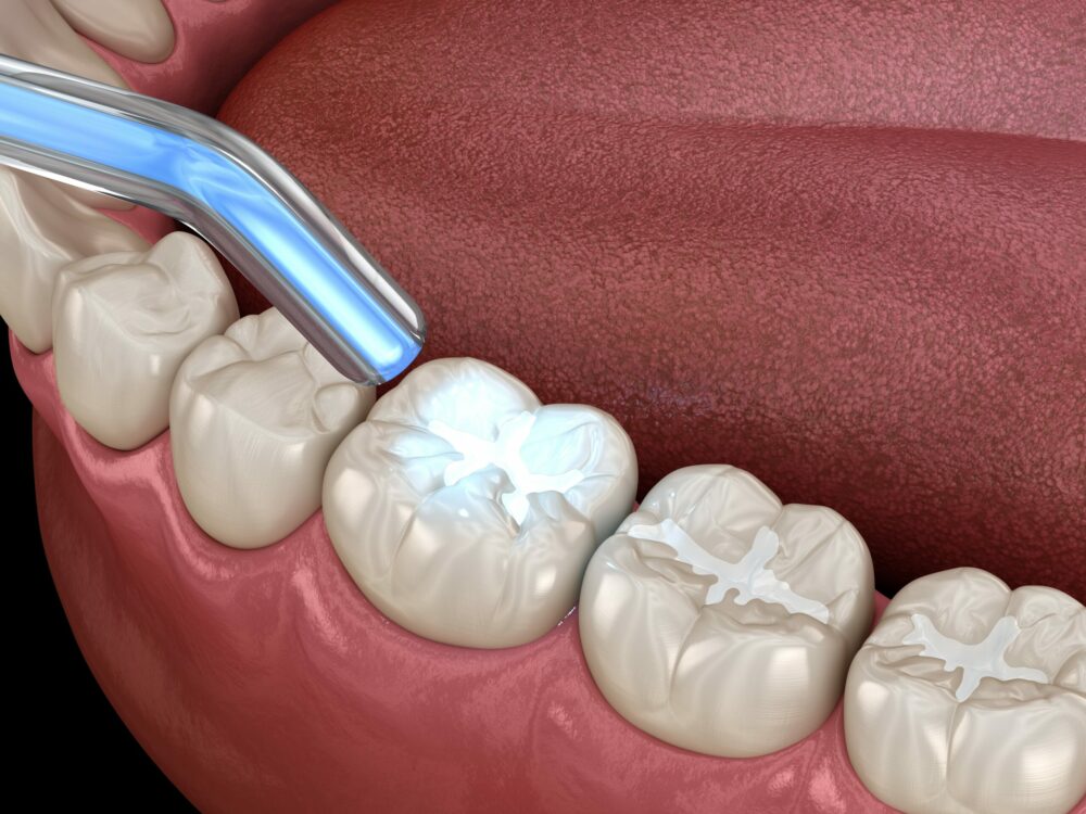 dental fillings auburn